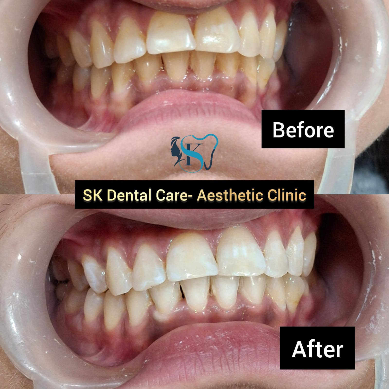 Dental Bleaching Treatment